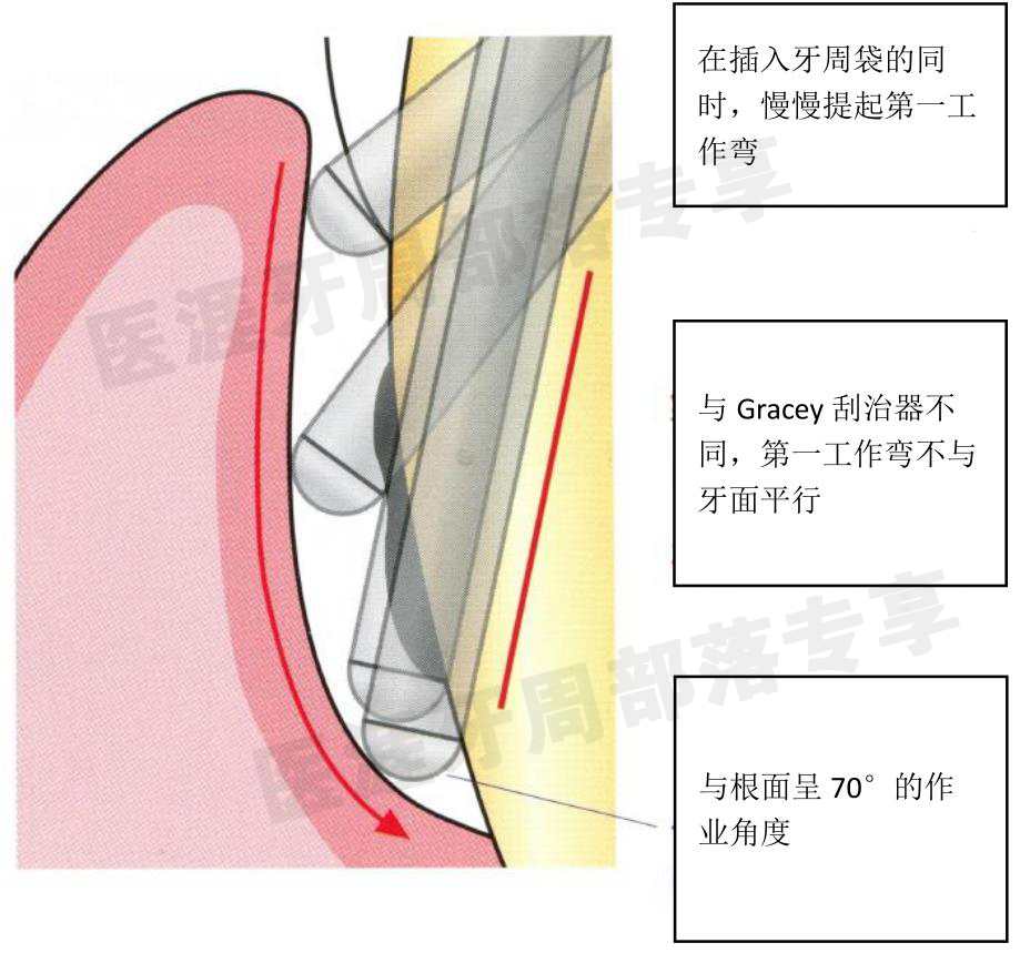怎么选洁牙器械5个要点带你学习器械洁牙_https://www.jmylbn.com_新闻资讯_第30张