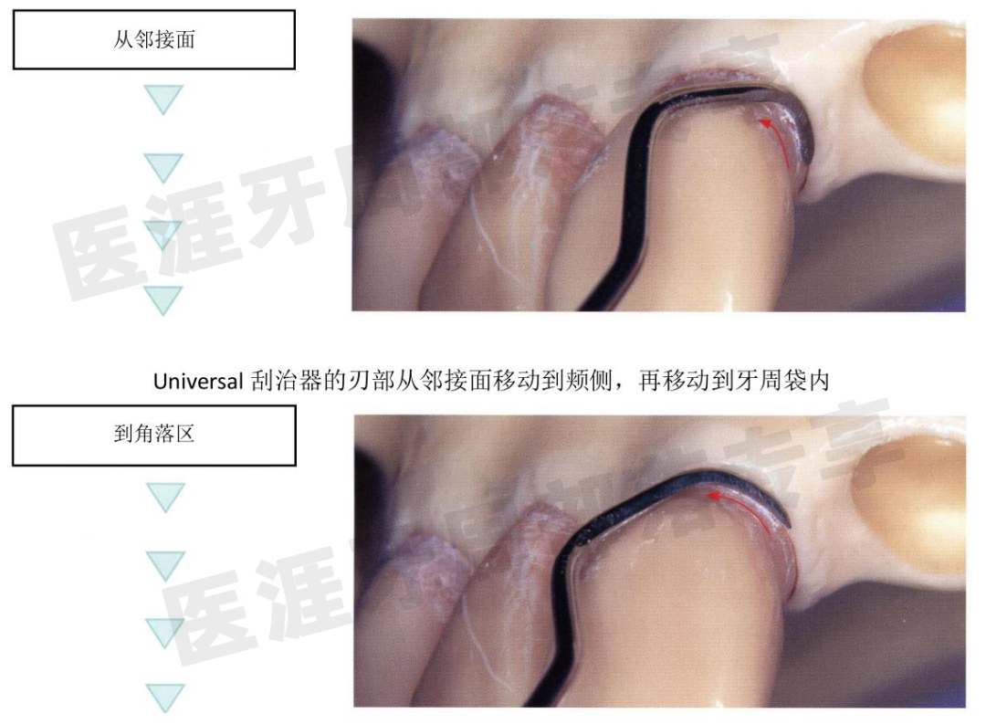 怎么选洁牙器械5个要点带你学习器械洁牙_https://www.jmylbn.com_新闻资讯_第6张