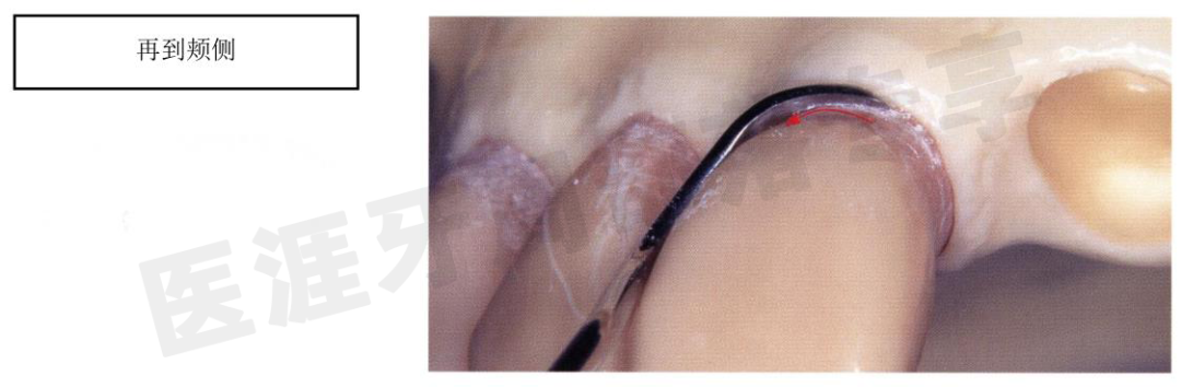 怎么选洁牙器械5个要点带你学习器械洁牙_https://www.jmylbn.com_新闻资讯_第7张