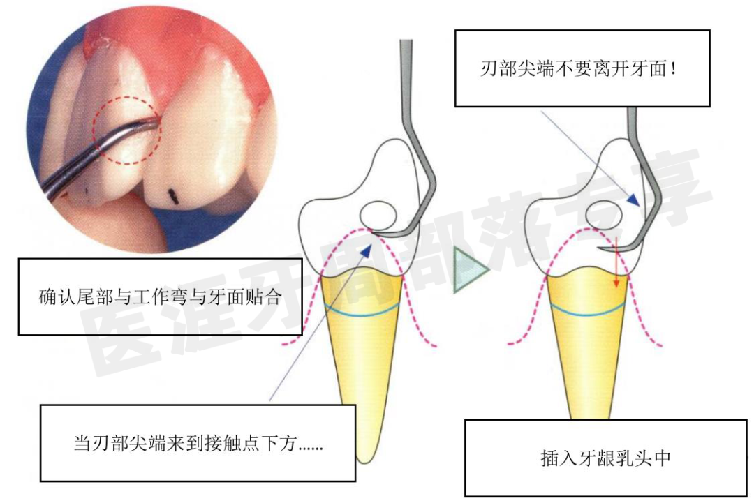 怎么选洁牙器械5个要点带你学习器械洁牙_https://www.jmylbn.com_新闻资讯_第22张