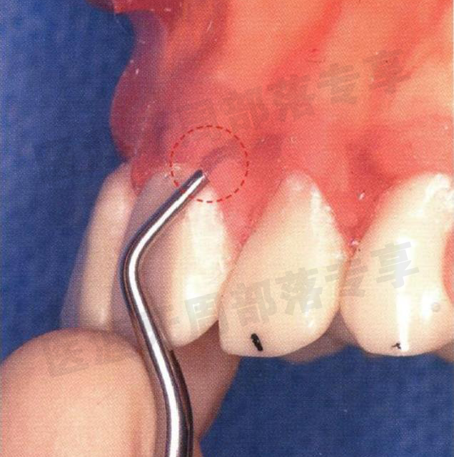 怎么选洁牙器械5个要点带你学习器械洁牙_https://www.jmylbn.com_新闻资讯_第25张