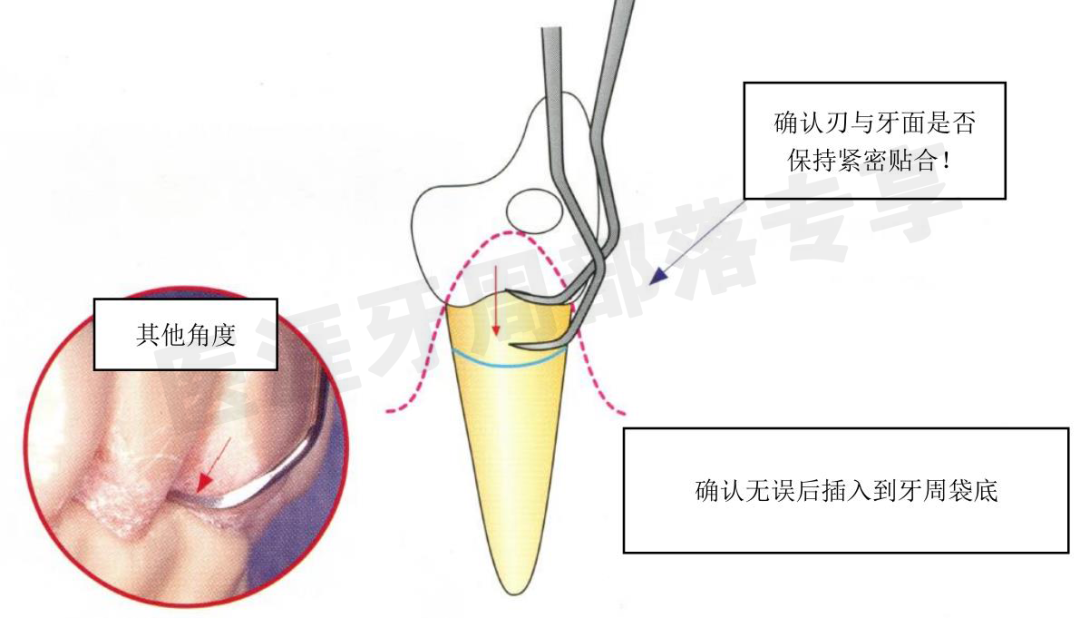怎么选洁牙器械5个要点带你学习器械洁牙_https://www.jmylbn.com_新闻资讯_第29张