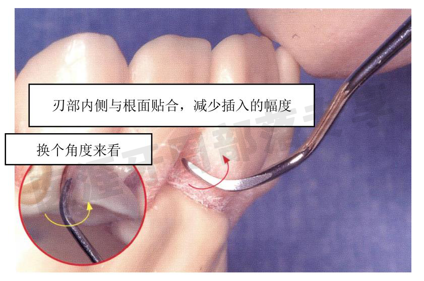 怎么选洁牙器械5个要点带你学习器械洁牙_https://www.jmylbn.com_新闻资讯_第27张