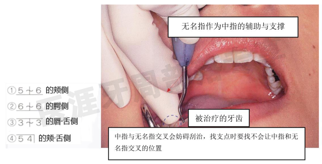 怎么选洁牙器械5个要点带你学习器械洁牙_https://www.jmylbn.com_新闻资讯_第16张