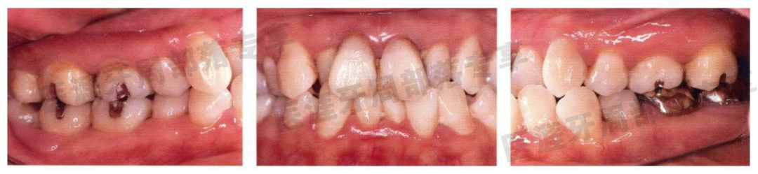 怎么选洁牙器械5个要点带你学习器械洁牙_https://www.jmylbn.com_新闻资讯_第36张