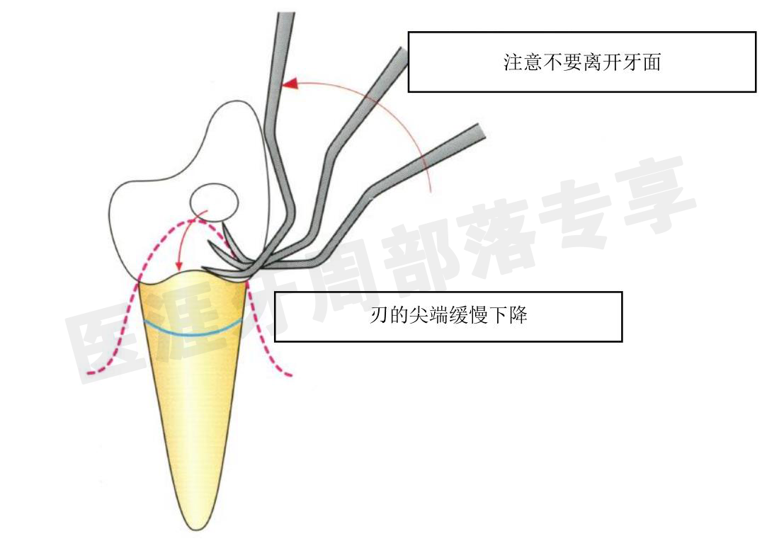 怎么选洁牙器械5个要点带你学习器械洁牙_https://www.jmylbn.com_新闻资讯_第28张
