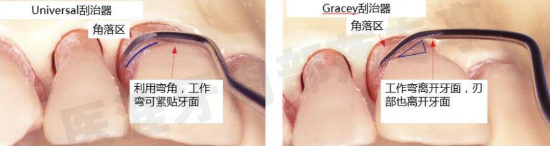 怎么选洁牙器械5个要点带你学习器械洁牙_https://www.jmylbn.com_新闻资讯_第4张