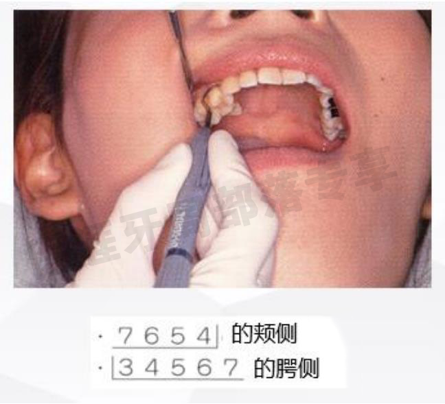 怎么选洁牙器械5个要点带你学习器械洁牙_https://www.jmylbn.com_新闻资讯_第14张