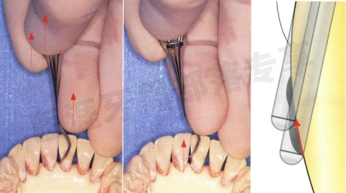 怎么选洁牙器械5个要点带你学习器械洁牙_https://www.jmylbn.com_新闻资讯_第33张