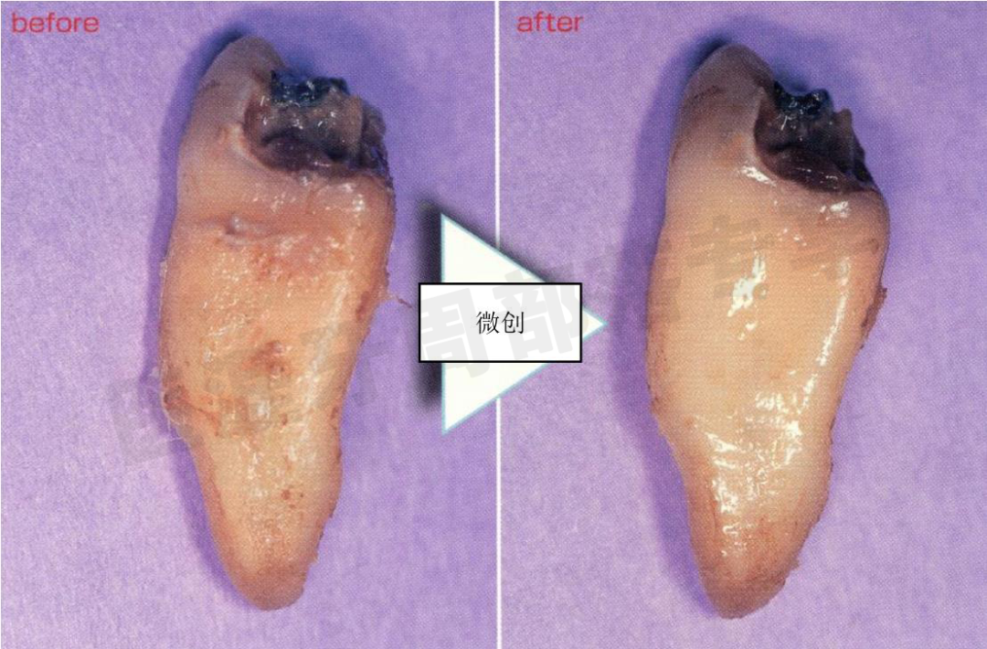怎么选洁牙器械5个要点带你学习器械洁牙_https://www.jmylbn.com_新闻资讯_第35张