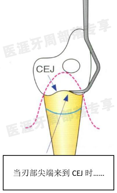 怎么选洁牙器械5个要点带你学习器械洁牙_https://www.jmylbn.com_新闻资讯_第24张