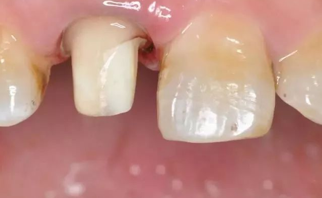 如何减轻固定修复后患牙酸痛问题