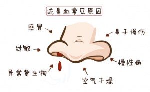 什么是电凝止血鼻子出血不要慌，一招电凝可搞定_https://www.jmylbn.com_新闻资讯_第4张