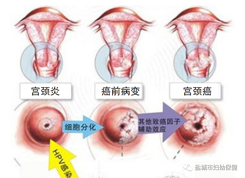 子宫颈癌的早期症状图片