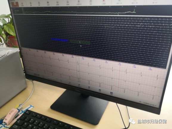 动态心电图自己怎么记录科普讲堂丨动态心电图及动态血压_https://www.jmylbn.com_新闻资讯_第6张