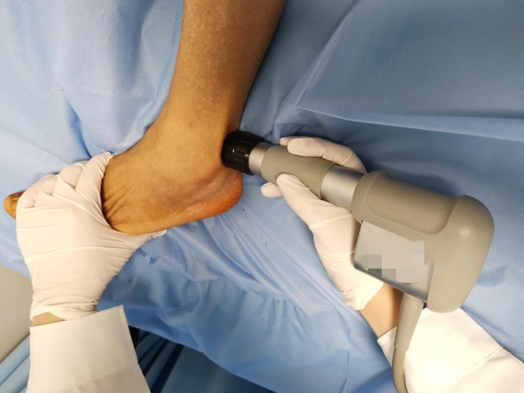 冲击波治疗效果怎么样冲击波疗法的原理、作用和适应症_https://www.jmylbn.com_新闻资讯_第7张