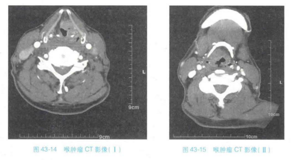 纤维喉镜怎么检查喉部特殊检查法方法及技巧大汇总_https://www.jmylbn.com_新闻资讯_第5张