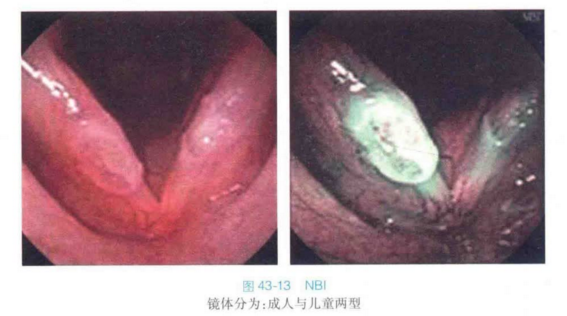 纤维喉镜怎么检查喉部特殊检查法方法及技巧大汇总_https://www.jmylbn.com_新闻资讯_第3张