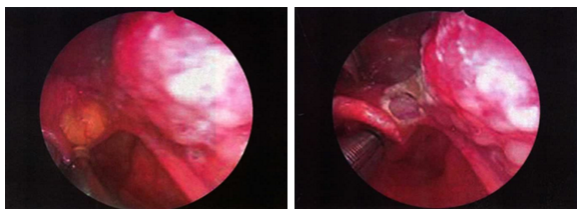 一文读懂等离子射频会厌囊肿切除术