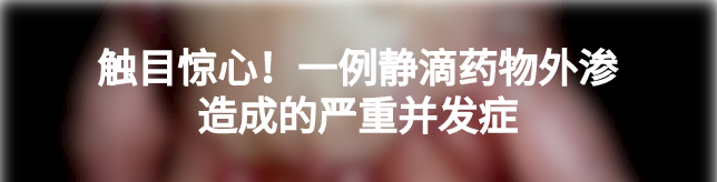 为什么输液管要粘上面慎重 ｜ 输液贴粘掉3cm×2cm的皮肤，这起医源性损害，转发提醒所有人_https://www.jmylbn.com_新闻资讯_第9张