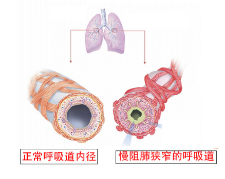 呼吸机怎么选择【健康星期天】畅快呼吸、倍感轻松——无创呼吸机的正确选择_https://www.jmylbn.com_新闻资讯_第7张