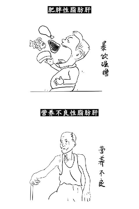 嚇skr人——脂肪肝為什麼可怕？ 健康 第5張