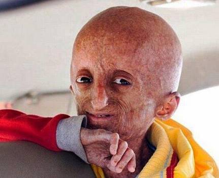 天启:儿童早衰症揭示人类老化秘密