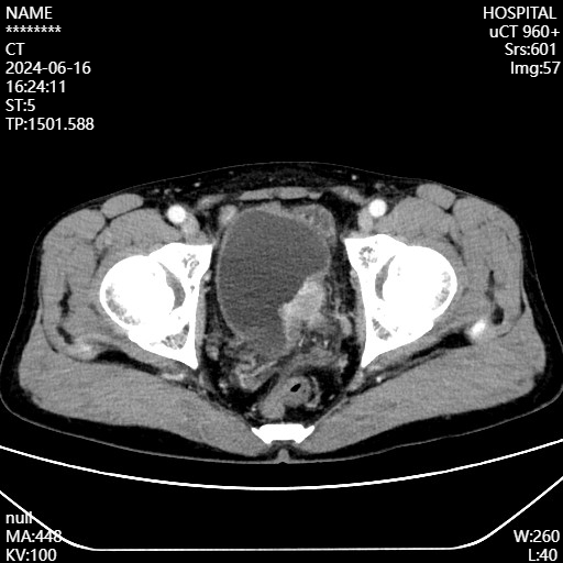 前列腺机器怎么治疗品质医疗丨我院泌尿外科成功实施高难度机器人辅助膀胱癌根治+回肠膀胱术_https://www.jmylbn.com_新闻资讯_第4张