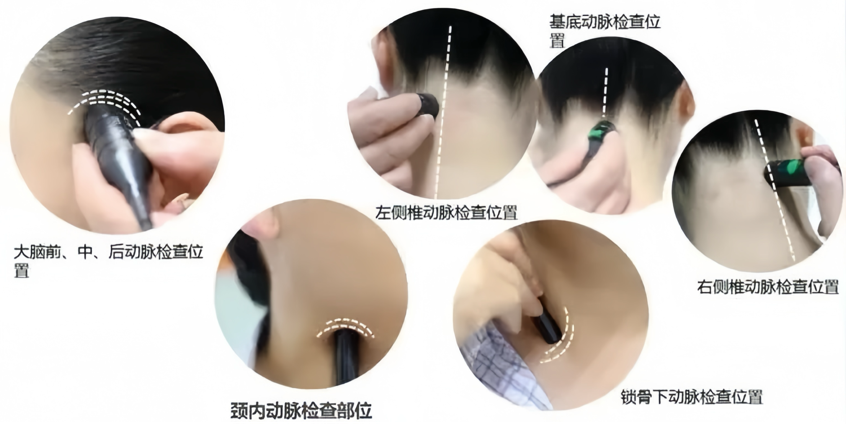 彩色经颅多普勒是什么健康有约丨揭秘脑血管的“侦察兵”——经颅多普勒超声(TCD)_https://www.jmylbn.com_新闻资讯_第9张