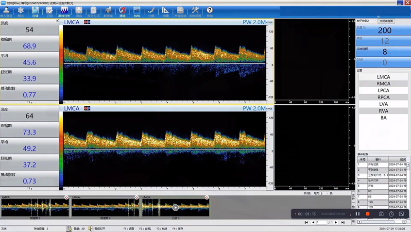 彩色经颅多普勒是什么健康有约丨揭秘脑血管的“侦察兵”——经颅多普勒超声(TCD)_https://www.jmylbn.com_新闻资讯_第12张