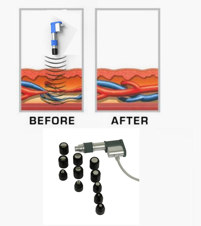 压力波是什么波关于洽圩压力波治疗仪的总结_https://www.jmylbn.com_新闻资讯_第10张