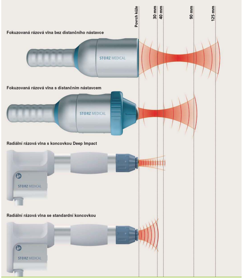 压力波是什么波关于洽圩压力波治疗仪的总结_https://www.jmylbn.com_新闻资讯_第7张