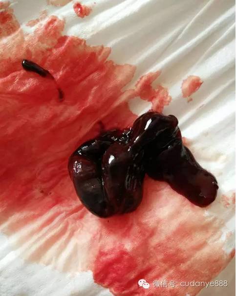 醋蛋归元液为何能调理子宫肌瘤为她收藏