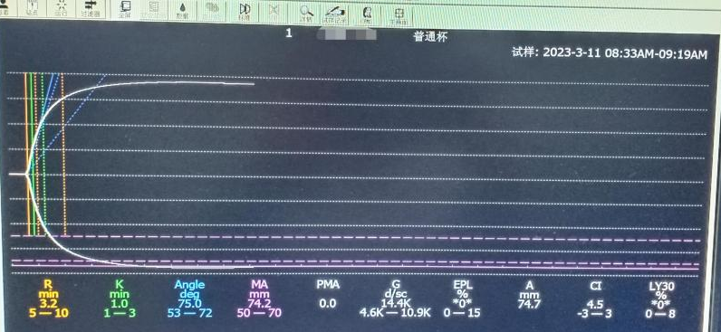 凝血4000怎么办【检验医学20】和“血栓弹力图”相识的一天🤚_https://www.jmylbn.com_新闻资讯_第7张