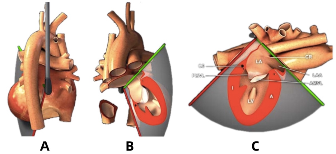 彩超探头怎么转换经食道心脏彩超（TEE）总看不懂？5 分钟掌握经典切面！（附动图）_https://www.jmylbn.com_新闻资讯_第14张