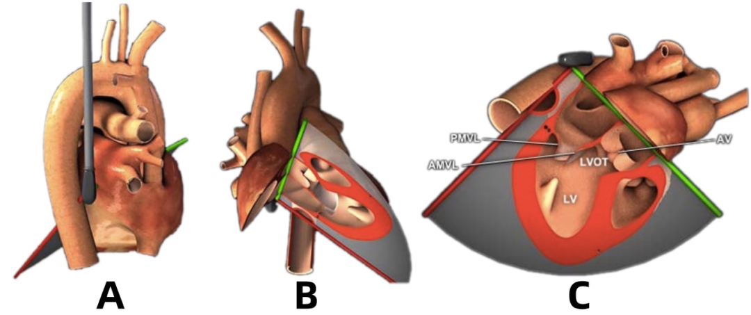 彩超探头怎么转换经食道心脏彩超（TEE）总看不懂？5 分钟掌握经典切面！（附动图）_https://www.jmylbn.com_新闻资讯_第16张