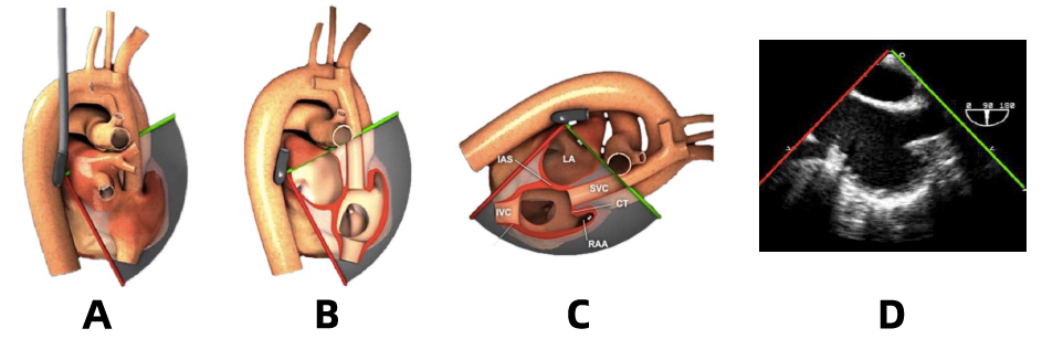 彩超探头怎么转换经食道心脏彩超（TEE）总看不懂？5 分钟掌握经典切面！（附动图）_https://www.jmylbn.com_新闻资讯_第5张