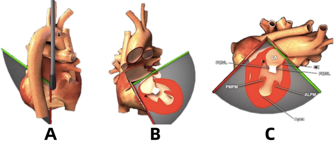 彩超探头怎么转换经食道心脏彩超（TEE）总看不懂？5 分钟掌握经典切面！（附动图）_https://www.jmylbn.com_新闻资讯_第11张
