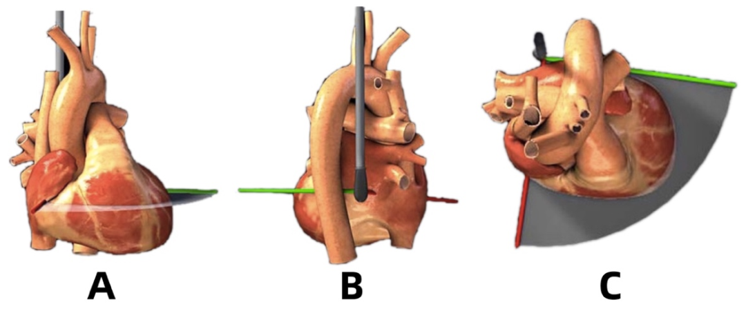 彩超探头怎么转换经食道心脏彩超（TEE）总看不懂？5 分钟掌握经典切面！（附动图）_https://www.jmylbn.com_新闻资讯_第8张