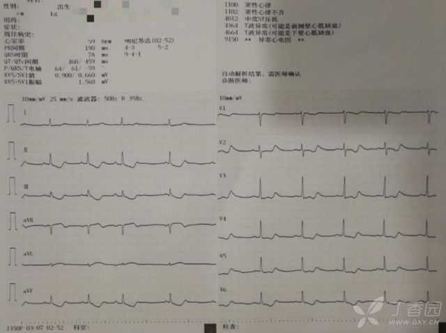 患者口服 300 片地高辛，全程心電圖如何演變？ 健康 第4張