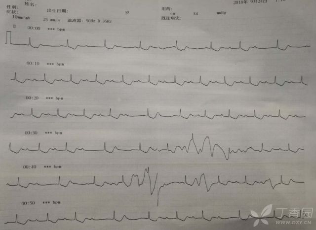 患者口服 300 片地高辛，全程心電圖如何演變？ 健康 第3張