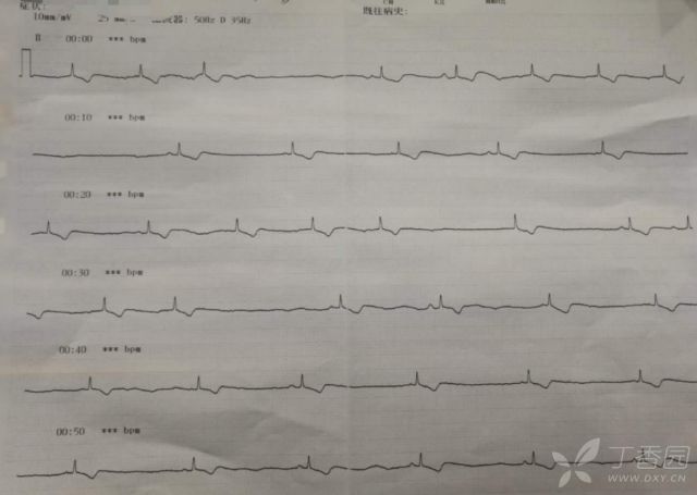 患者口服 300 片地高辛，全程心電圖如何演變？ 健康 第2張