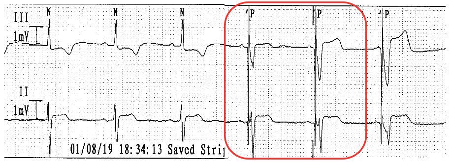 为什么双极不起博只会看常规心电图？远不够，这 4 种起搏心电图你会看吗？｜ 上海心律失常论坛_https://www.jmylbn.com_新闻资讯_第5张