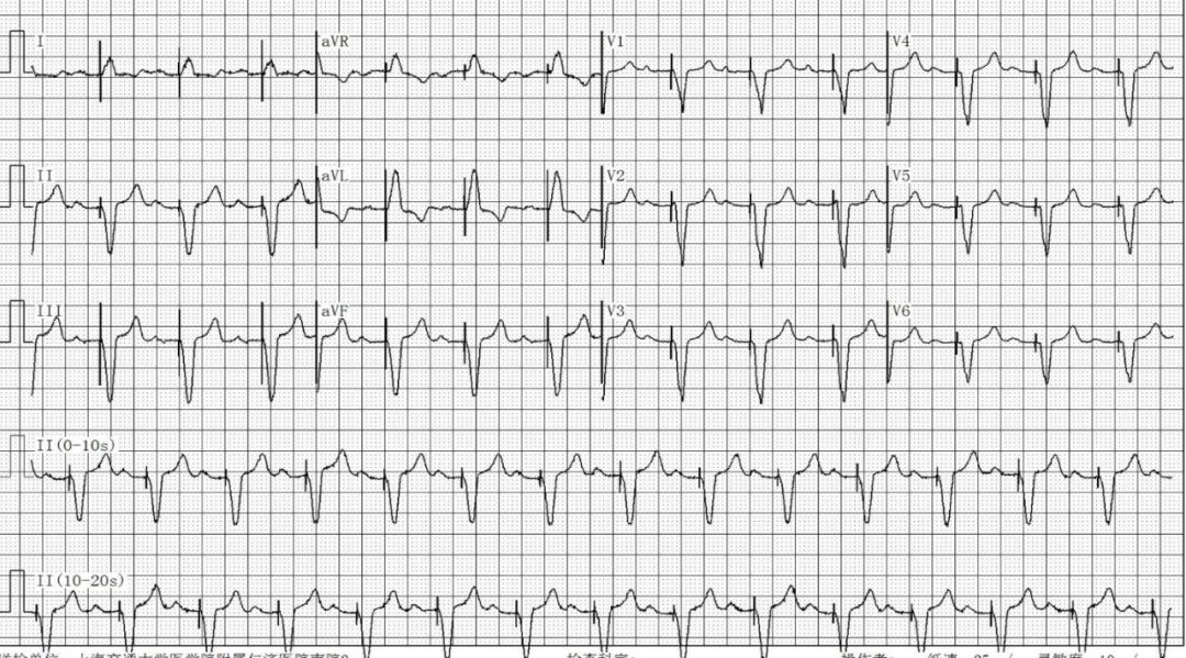 为什么双极不起博只会看常规心电图？远不够，这 4 种起搏心电图你会看吗？｜ 上海心律失常论坛_https://www.jmylbn.com_新闻资讯_第11张