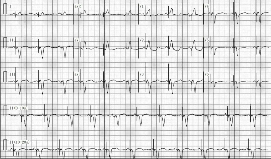 为什么双极不起博只会看常规心电图？远不够，这 4 种起搏心电图你会看吗？｜ 上海心律失常论坛_https://www.jmylbn.com_新闻资讯_第13张