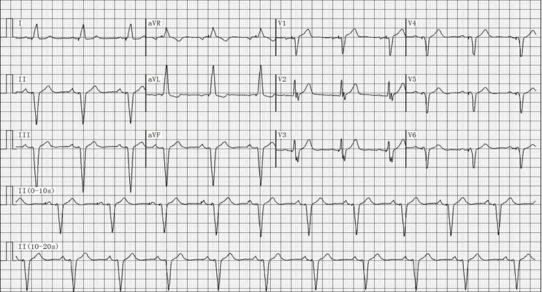 为什么双极不起博只会看常规心电图？远不够，这 4 种起搏心电图你会看吗？｜ 上海心律失常论坛_https://www.jmylbn.com_新闻资讯_第22张
