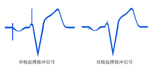 为什么双极不起博只会看常规心电图？远不够，这 4 种起搏心电图你会看吗？｜ 上海心律失常论坛_https://www.jmylbn.com_新闻资讯_第3张