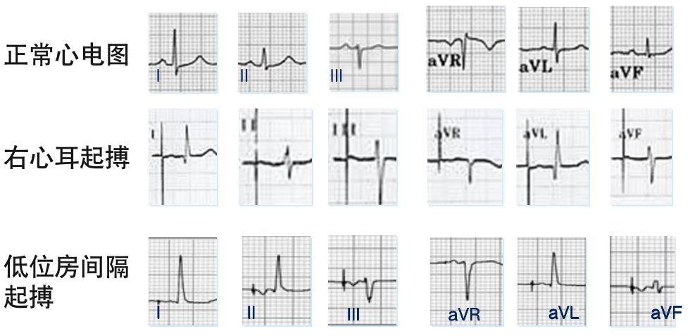 为什么双极不起博只会看常规心电图？远不够，这 4 种起搏心电图你会看吗？｜ 上海心律失常论坛_https://www.jmylbn.com_新闻资讯_第4张