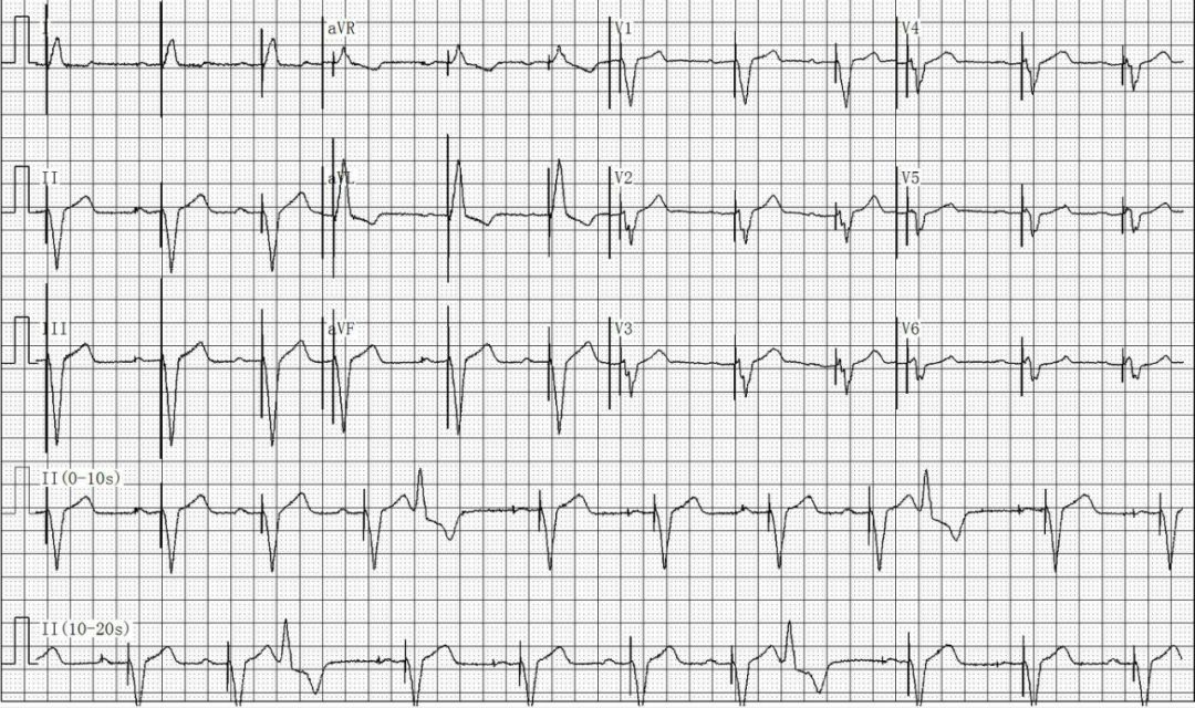 为什么双极不起博只会看常规心电图？远不够，这 4 种起搏心电图你会看吗？｜ 上海心律失常论坛_https://www.jmylbn.com_新闻资讯_第23张