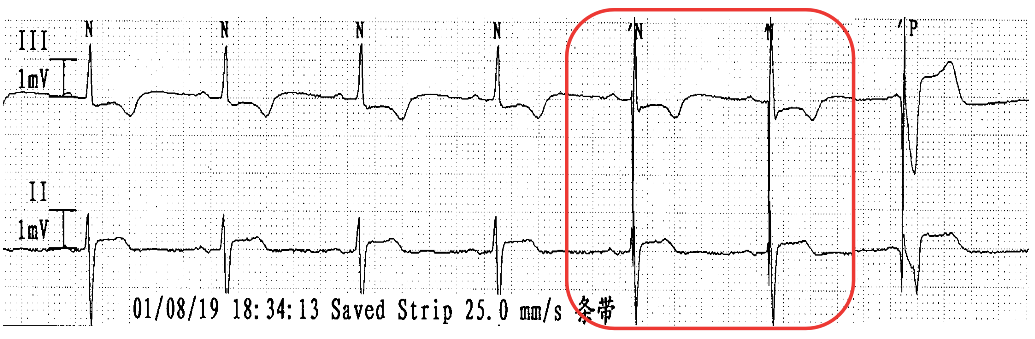 为什么双极不起博只会看常规心电图？远不够，这 4 种起搏心电图你会看吗？｜ 上海心律失常论坛_https://www.jmylbn.com_新闻资讯_第6张